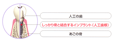 インプラントの仕組み